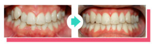 Vergleich Vorher-Nachher: Schiefe Zähne