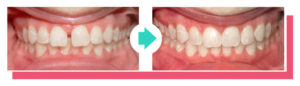 Vergleich Vorher-Nachher: Zahnlücken