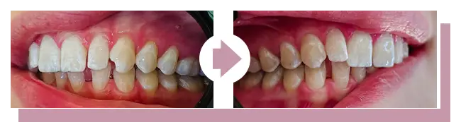 Vorher-Nachher: Zahnkorrektur (schiefe Zähne)