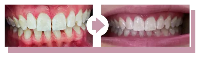 Vorher-Nachher: Zahnkorrektur (schiefe Zähne)