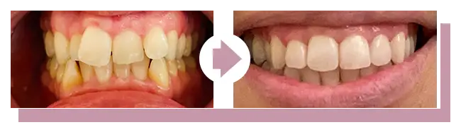 Vorher-Nachher: Zahnkorrektur -03.2026