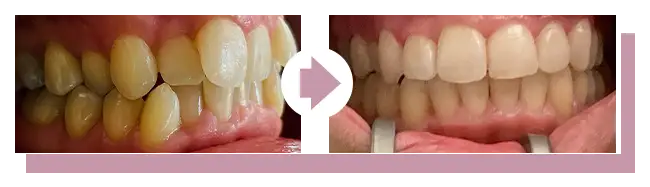 Vorher-Nachher: Zahnkorrektur -03.2026