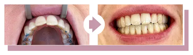 Korrektur bei leichter Frontfehlstellung (Praxisbild)