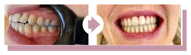 Korrektur bei frontal leicht offenem Biss (Praxisbild)